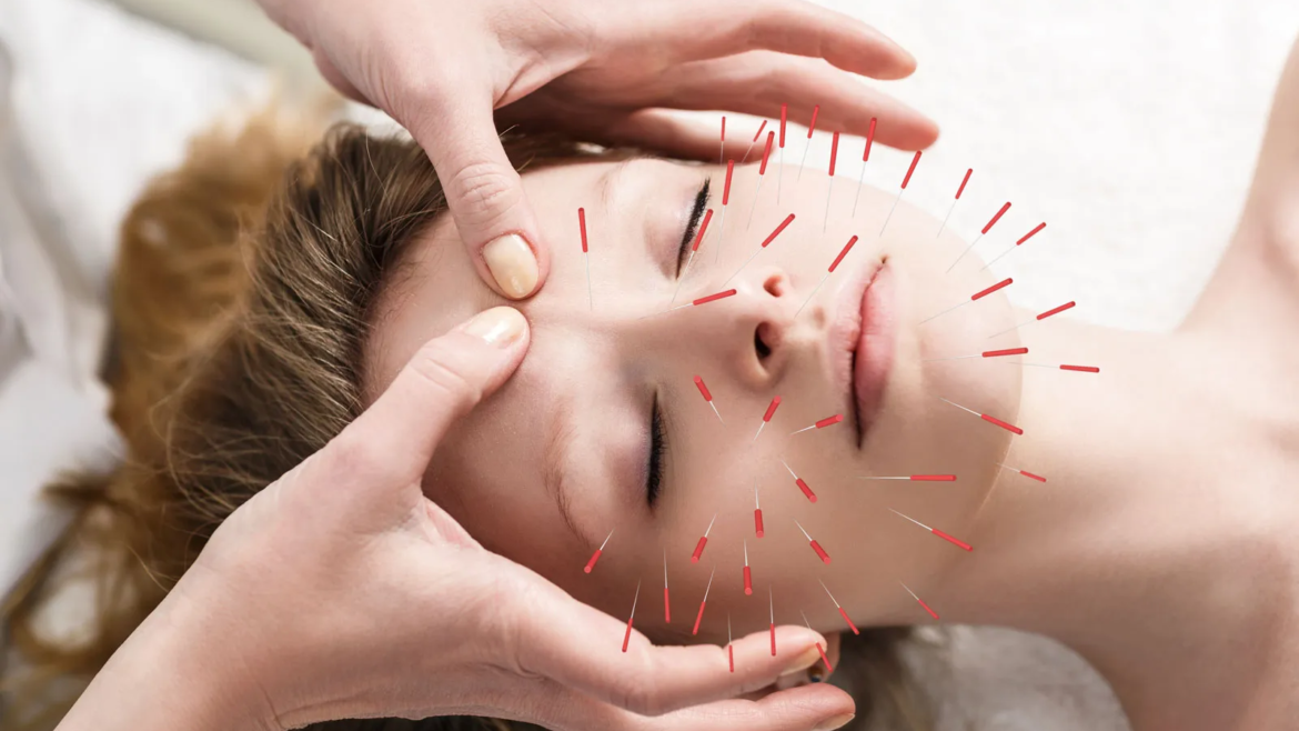 Acupuncture and Traditional Chinese Medicine