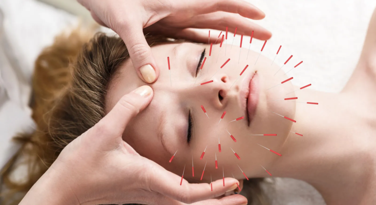 Acupuncture and Traditional Chinese Medicine