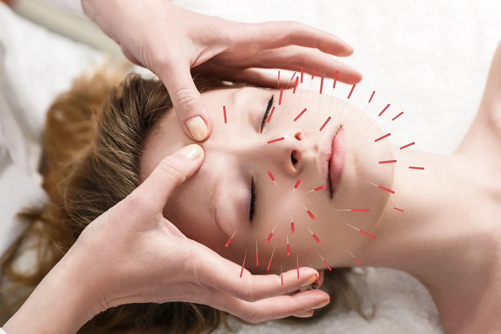 Acupuncture and Traditional Chinese Medicine