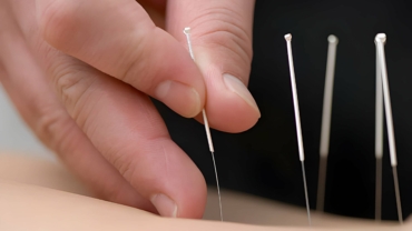 The Healing Power of Acupuncture: How It Works and What to Expect