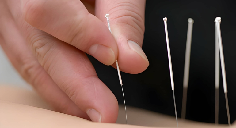 The Healing Power of Acupuncture: How It Works and What to Expect