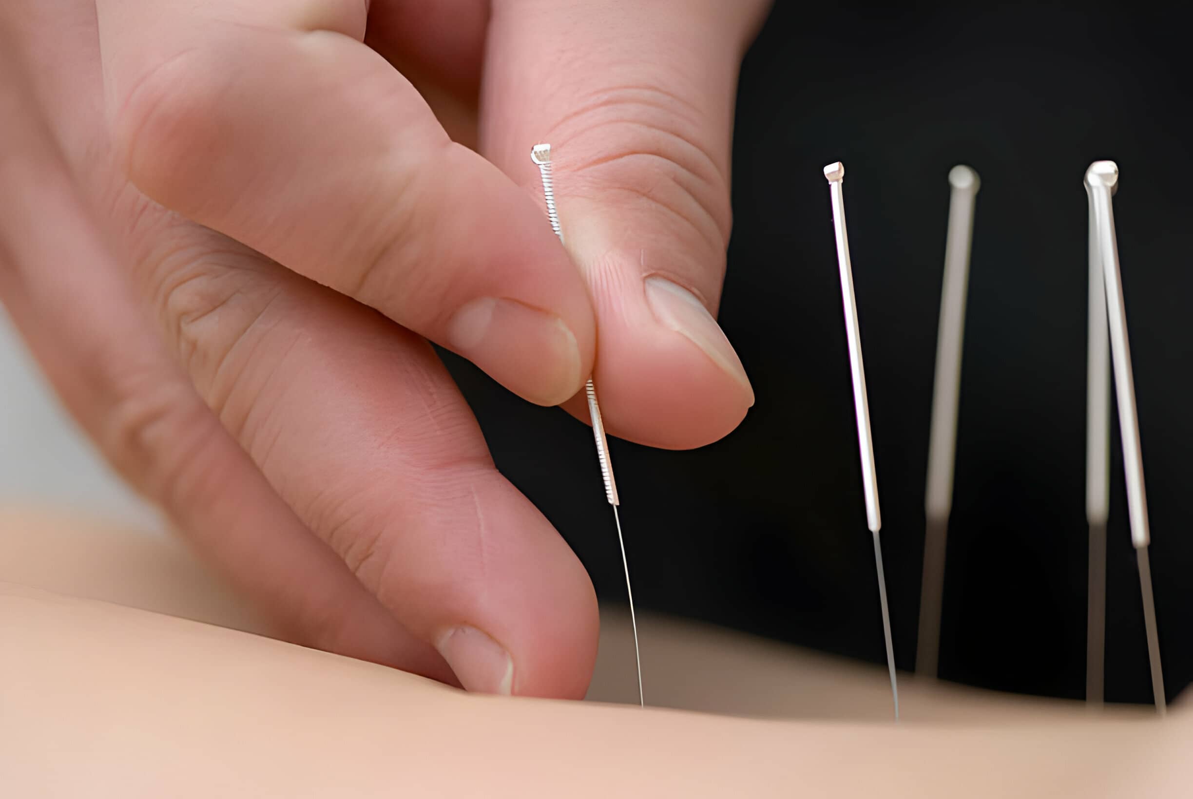 The Healing Power of Acupuncture: How It Works and What to Expect